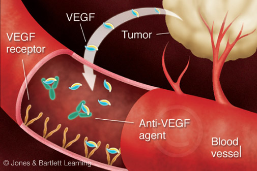 Illustration of Anti_VEGF Tumor Treatment